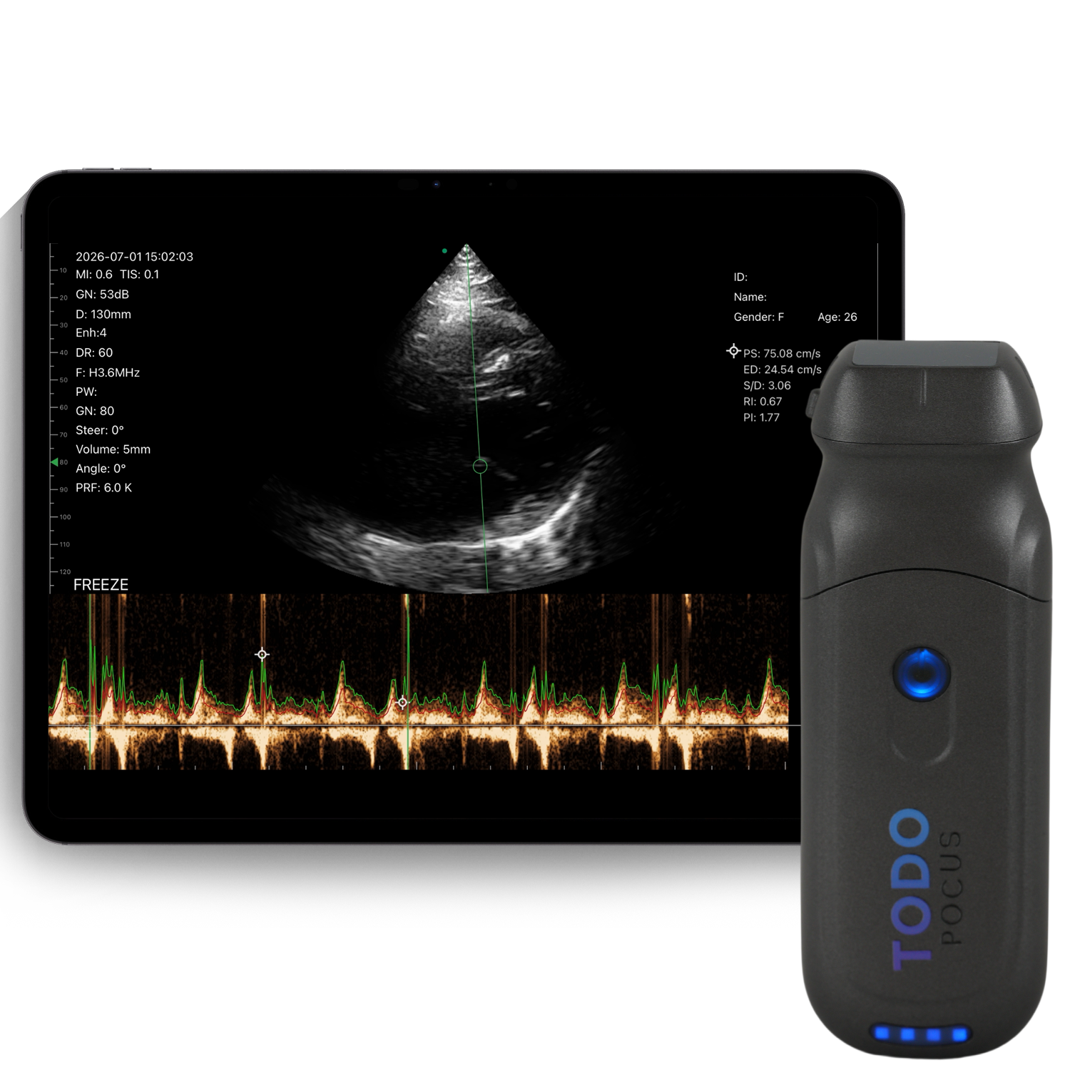 pd2 phased array handheld ultrasound scanner with cw doppler for cardiac echo